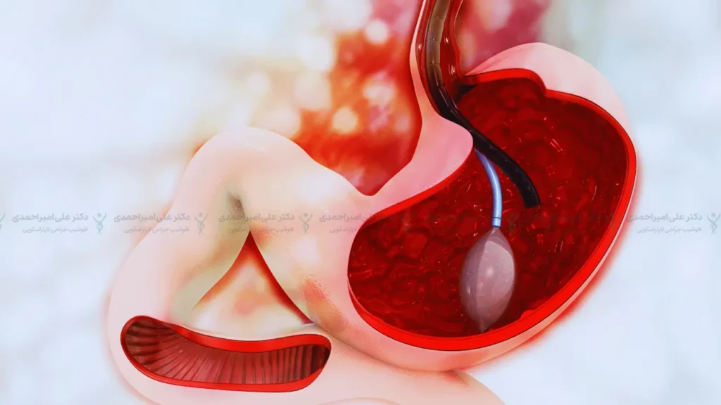 عکس شماتیک نحوه تزریق بوتاکس معده