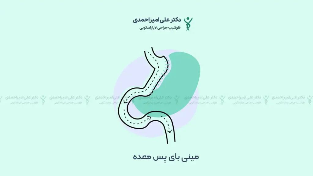 عکس شماتیک عمل لاغری مینی بای پس معده