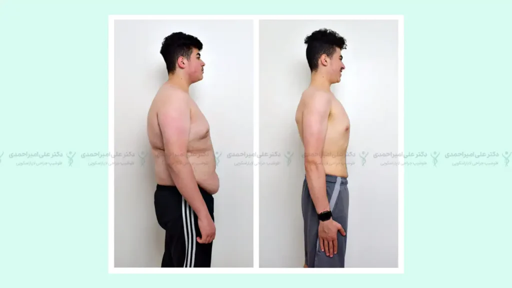 عکس قبل و بعد از بوتاکس معده