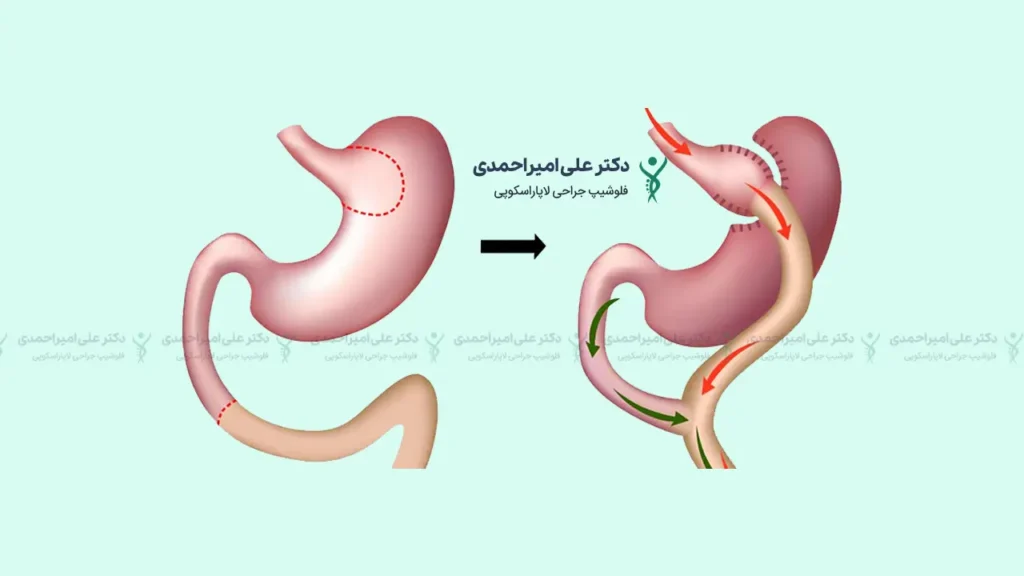 عمل بای پس معده کلاسیک