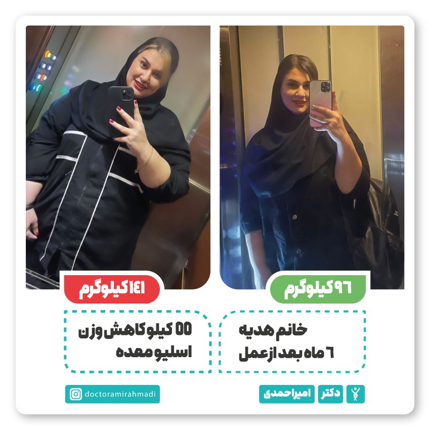 عکس قبل و بعد از عمل اسلیو معده 1