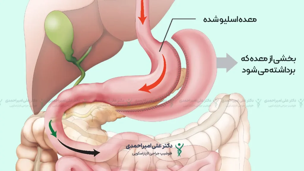 اینفوگرافی اسیلو معده: توضیح بخش جدا شده و باقی مانده معده در طول جراحی اسلیو
