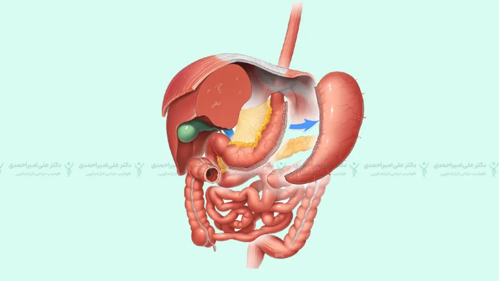 عمل اسلیو معده