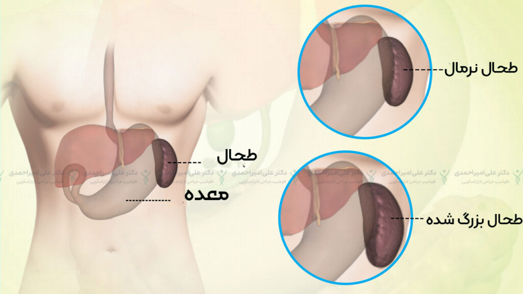 مقایسه طحال نرمال و بزرگ شده