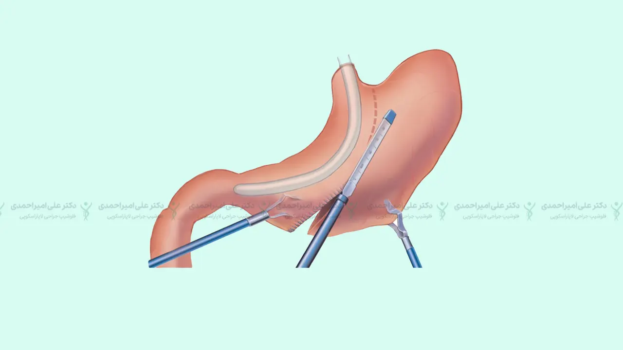 استاپلر اسلیومعده که هزینه اسلیو معده را به شدت بالا می برد