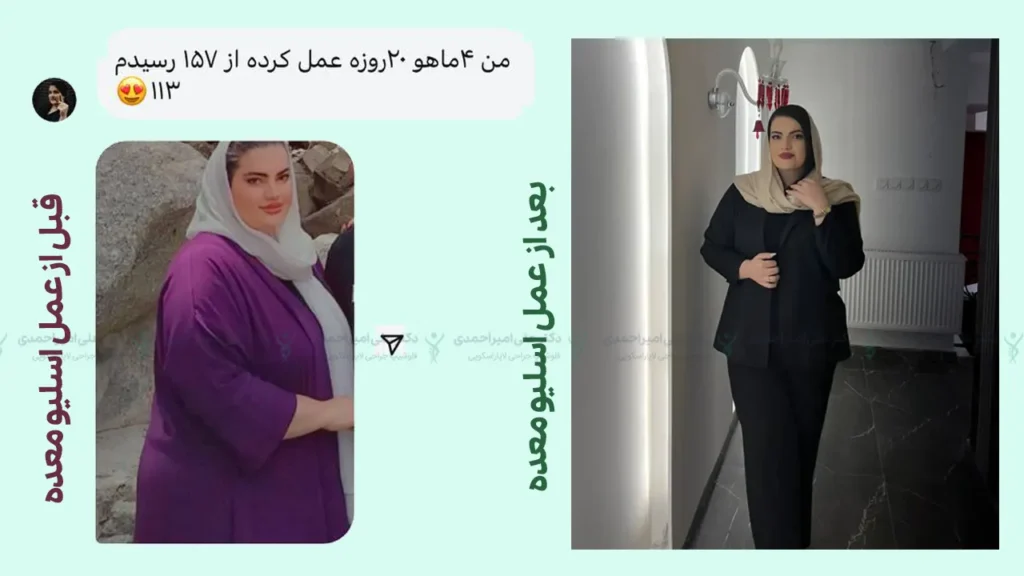 عکس قبل و بعد از عمل اسلیو معده و تجربیات کسانی که عمل اسلیو انجام داده اند.