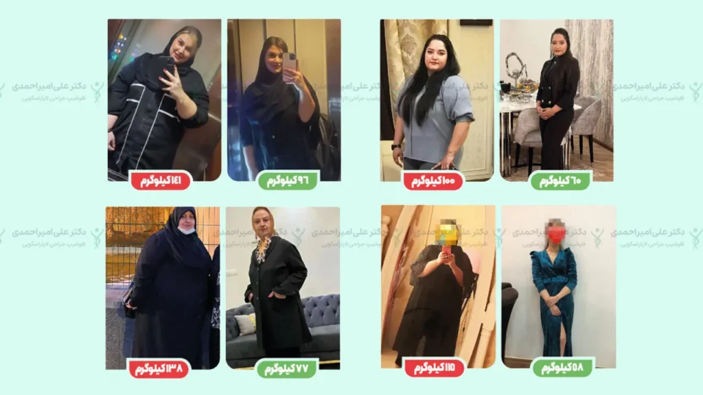 عکس قبل و بعد از عمل اسلیو معده
